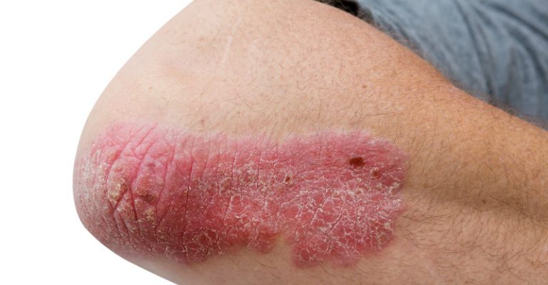 Treatments for Ostraceous Scaly Psoriasis