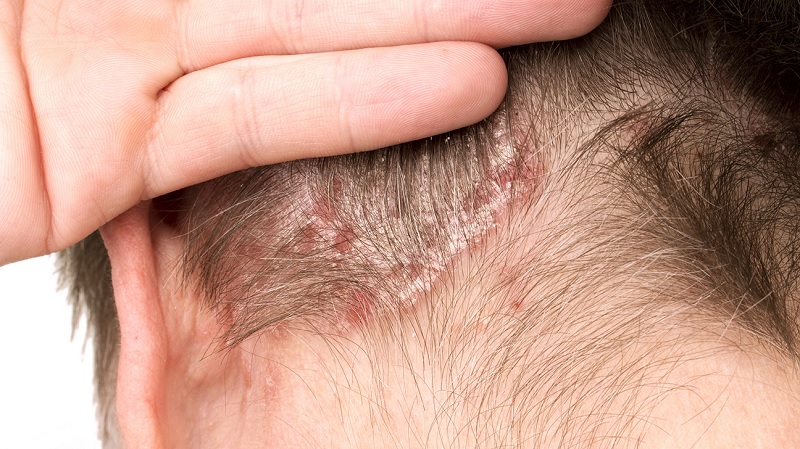 Sores On Scalp Causes | Easy Health Care Solution - RooHealthCare