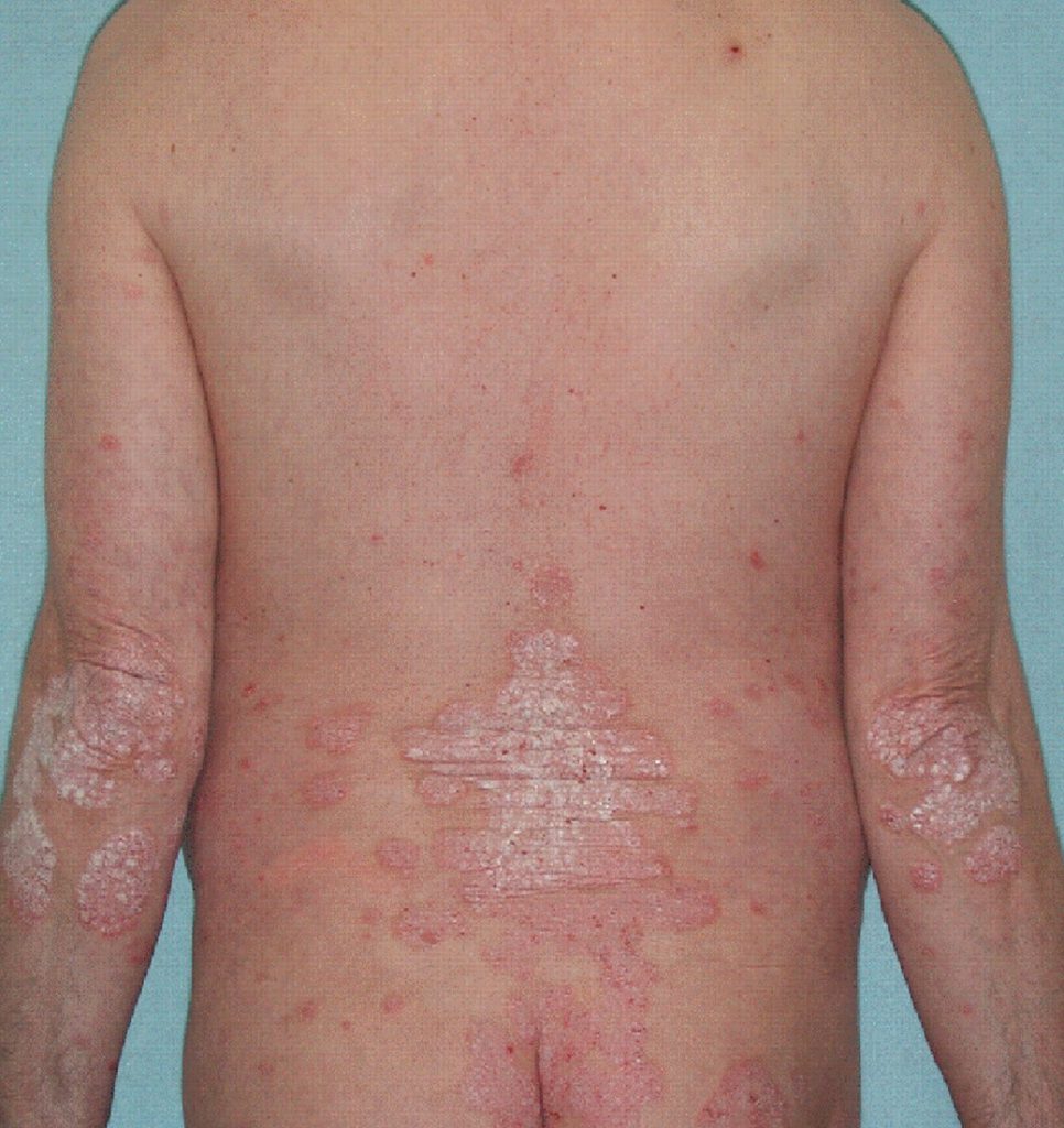 Treatments for Ostraceous Scaly Psoriasis Easy Health Care Solution