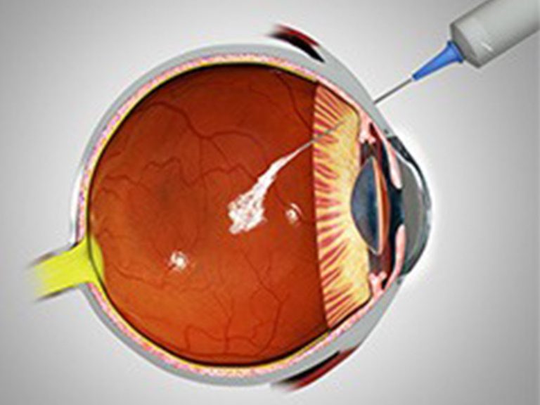 Retinal Injection to Treat Detachment Easy Health Care Solution