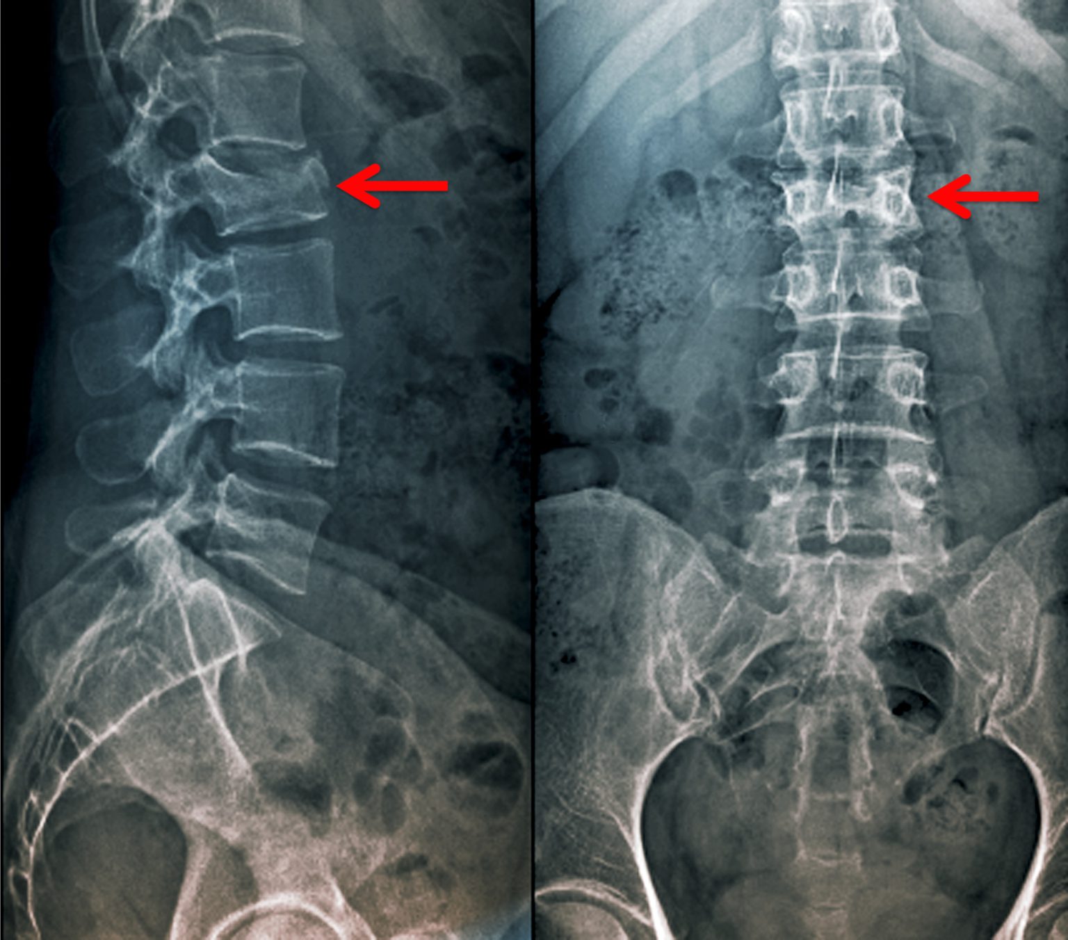 symptoms-thoracic-wedge-fracture-easy-health-care-solution