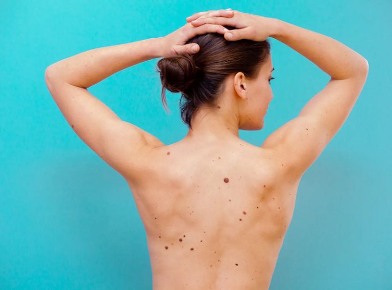 What Are Sun Cancer Spots?