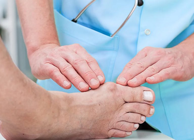 Rheumatoid Arthritis Feet Symptoms
