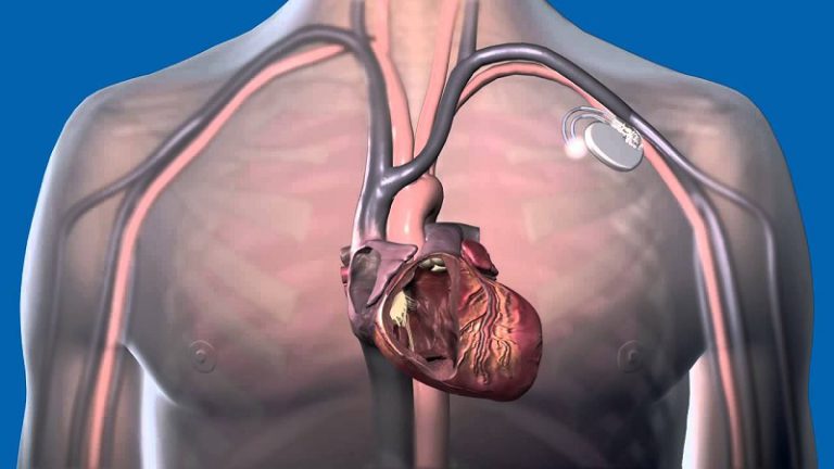What is a Human Heart Pacemaker?