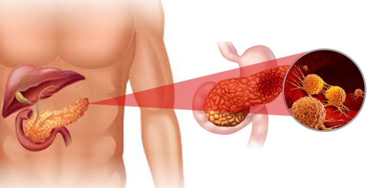 Symptoms of Ampulla Pancreas Cancer
