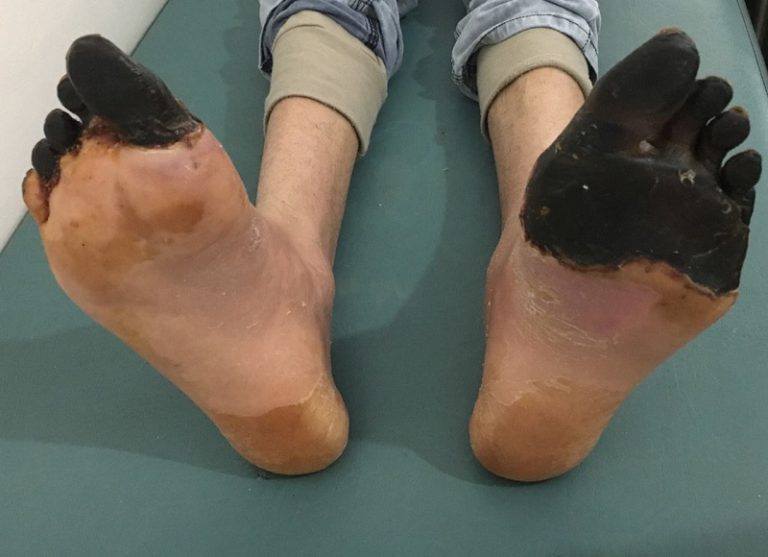 Necrosis Foot – What is Necrosis Foot and How to Prevent It
